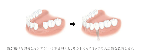 インプラント治療