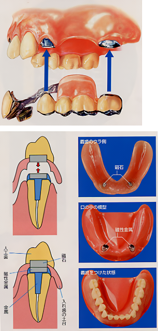 全義歯でも、部分義歯でも対応可能です