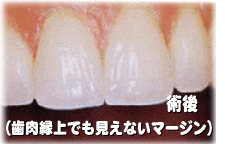 ホワイトニングやセラミックで自然な白さを目指す
