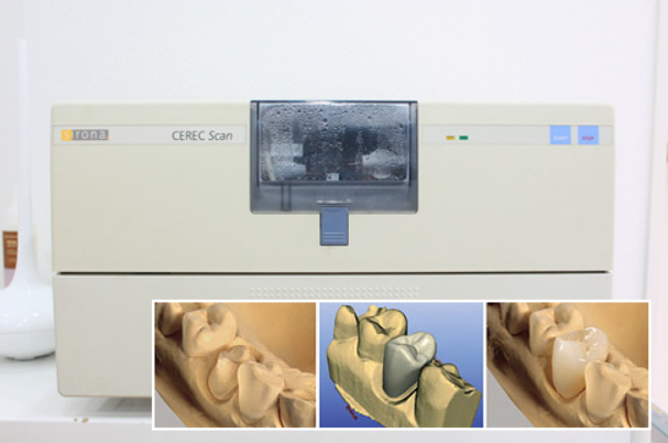 セレックならスピーディで高品質なセラミック治療が可能です