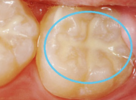 お子様の歯の健康を守ります