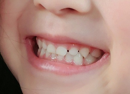 成長段階に応じた予防と治療を通じて、お子様が生涯にわたり健康な歯を保てるよう支援しています。