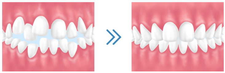 矯正治療で機能性も向上します