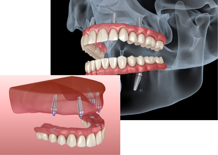日本口腔インプラント学会認定の専門医がすべての手術を担当しています。