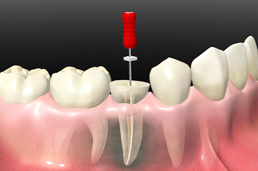 天然歯を出来る限り守る治療を行います