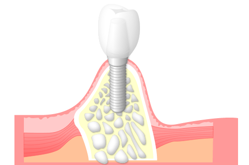 入れ歯やブリッジ治療も考慮したうえで、患者様に一番適していると思った際に治療を推奨します