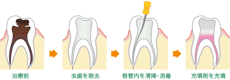 むし歯の進行度に応じた丁寧な治療を行っています
