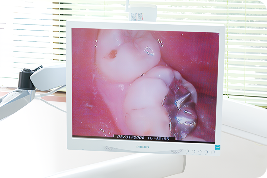 再感染のリスクを抑えつつ、歯をできるだけ長く残す治療を実現しています。