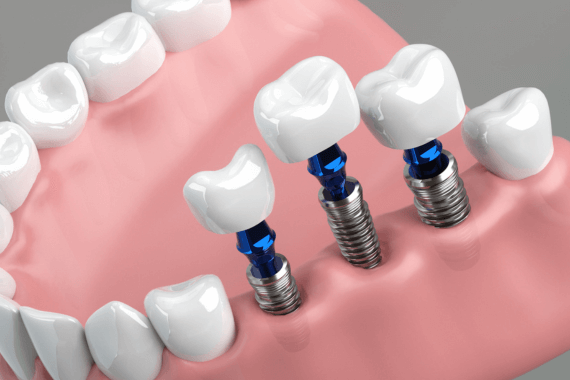 最新のCT技術と専門知識を活かした長期的な噛む機能の回復
