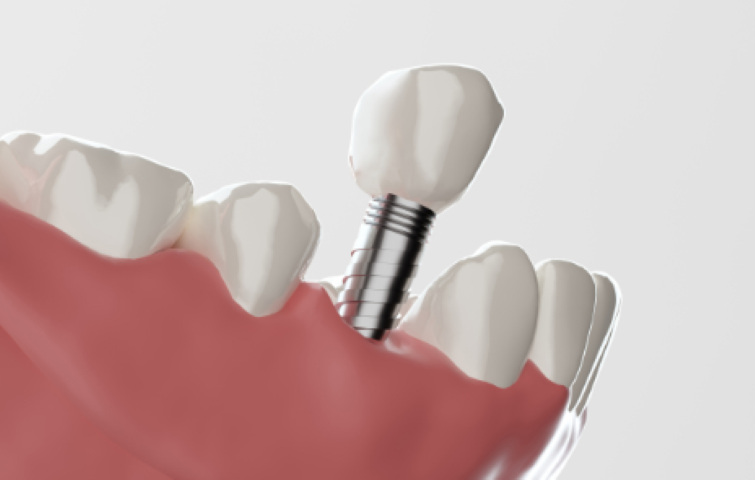 高品質なインプラント治療を提供