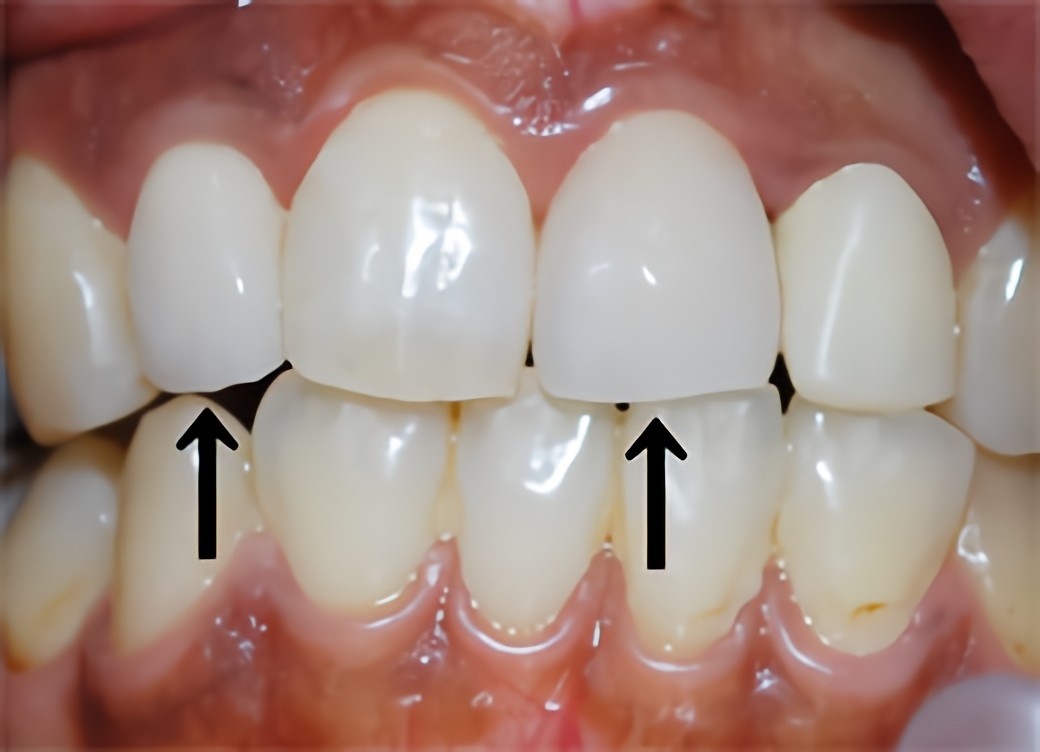オールハイブリッド冠