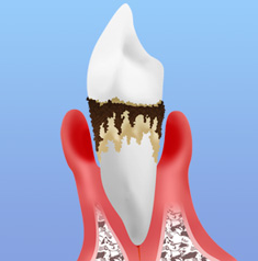 歯周病