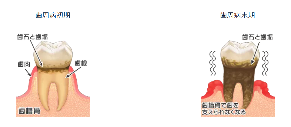 痛みが少ないため、気づいたときには病気が進行していることが多く、歯を失う原因となるだけでなく、細菌が全身に影響を与えることもあります。