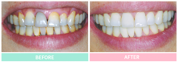 歯の色や形を整え、自然な美しさと機能性を両立させた治療を提供しています