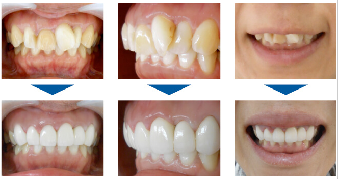 セラミックで見た目も美しく整えます