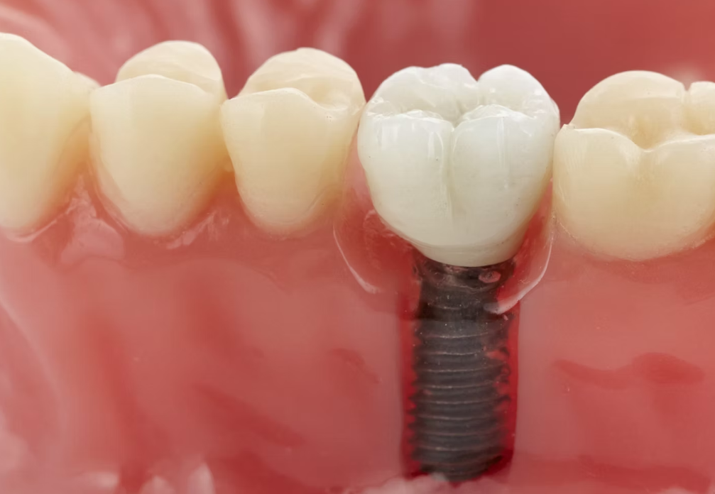 専門的な外科処置で親知らずからインプラントまで幅広く対応