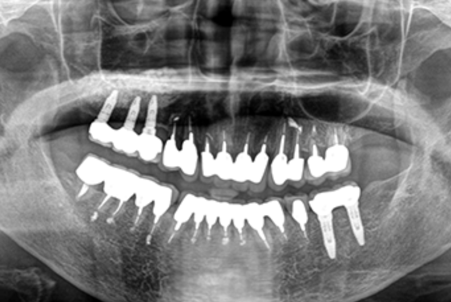 高品質なインプラント材料と骨造成技術による安心で長期的な補綴治療