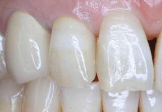 かぶせ物を白い素材に