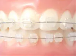 ホワイトプラザ歯科の歯科矯正の相談は無料です。