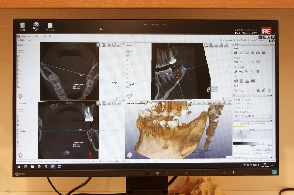 患者様に合ったインプラント治療を提供しています