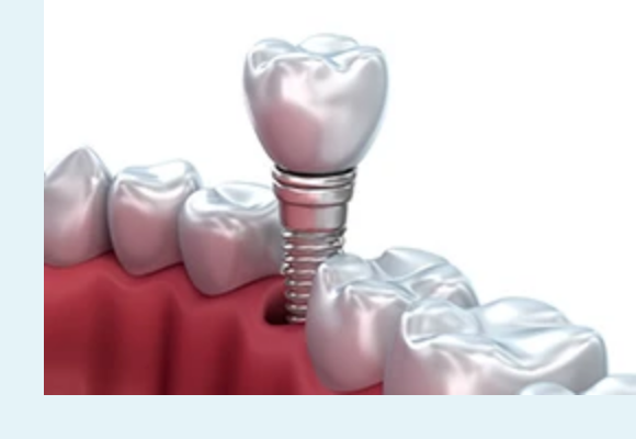 噛んだ時の感触や噛みごたえが自分の歯に限りなく近いインプラント