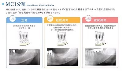 骨粗しょう症のリスクをチェック
