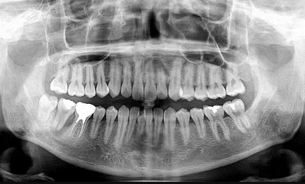 歯と歯周組織の関係を保つ治療