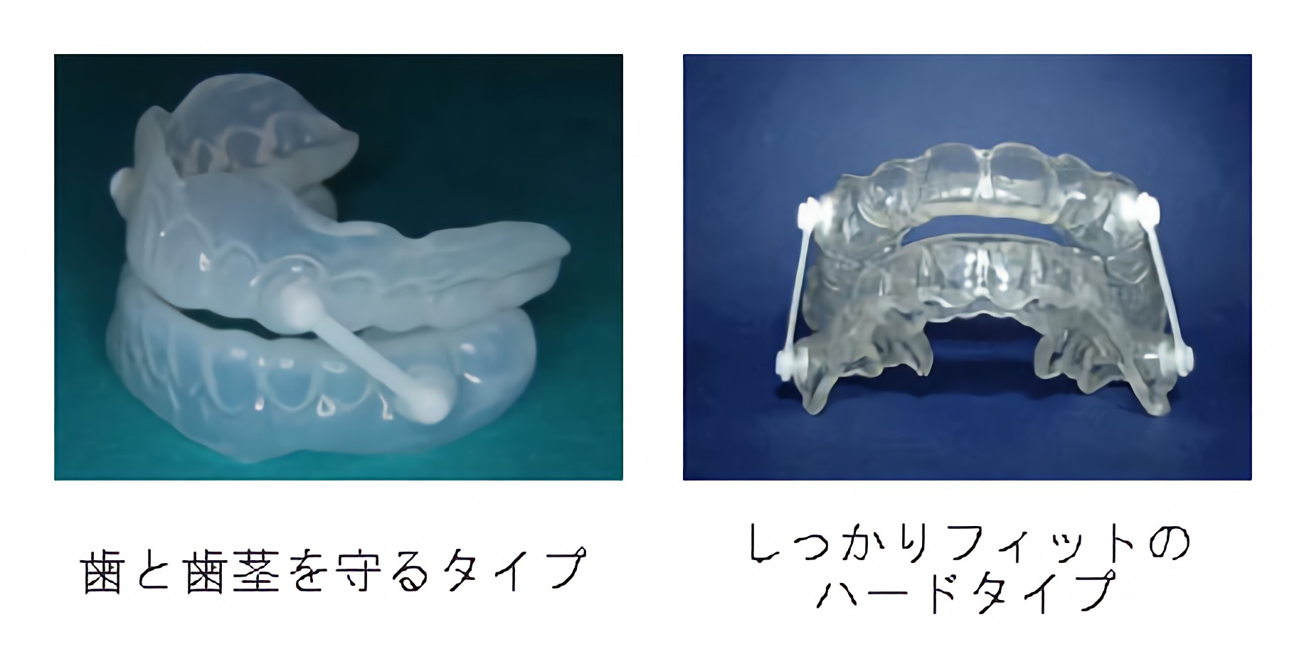 症状に合わせたマウスピースを作成します