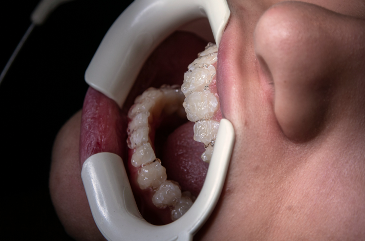 機能美を追求した審美歯科治療