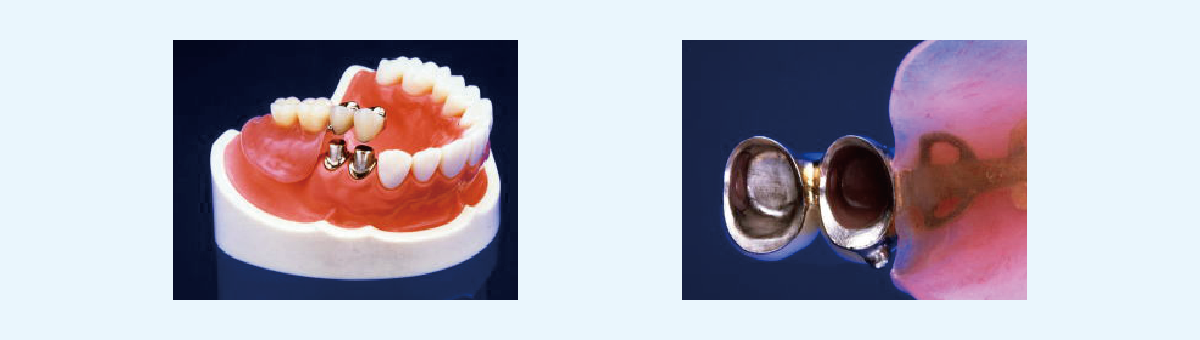 画期的な義歯システムを提供します