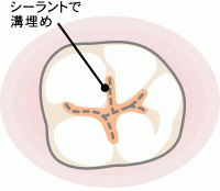 シーラントで奥歯の虫歯を予防できます