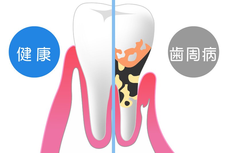 健康な歯と歯周病になった歯の違い