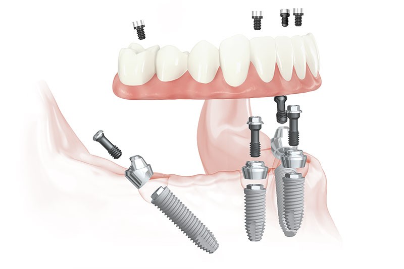 全ての歯を失った方や総入れ歯に悩む方に向け、「オールオン4・6」を提供しています