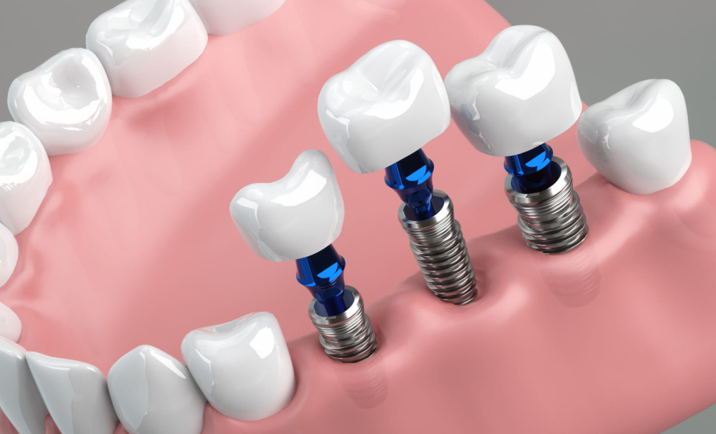 インプラントは安心の10年保証