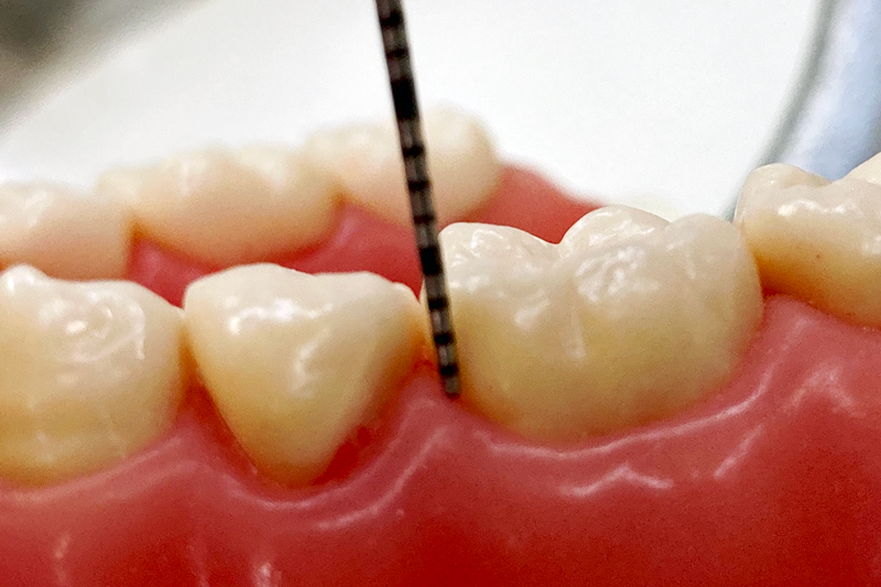 早期発見が歯の寿命を延ばす鍵