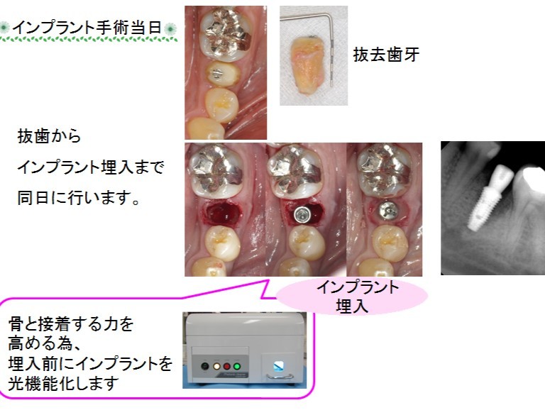 抜歯と同日にインプラント埋入手術を行った症例があります