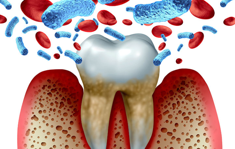 患者様とともに取り組む長期的な歯周病管理