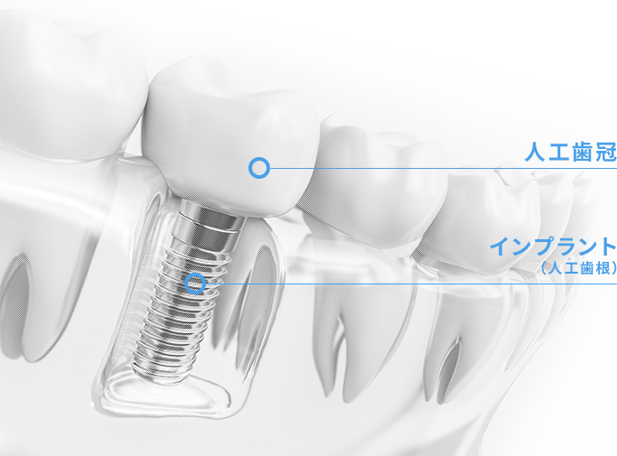 自然な見た目のインプラント治療