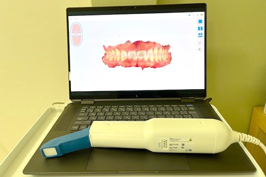 口腔内スキャナー（iTero)を導入