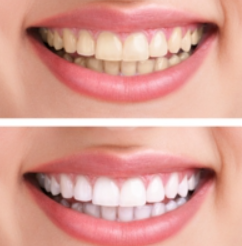 白く清潔感のある口元に導きます