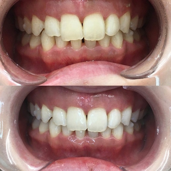 ホワイトニングの施術例となります