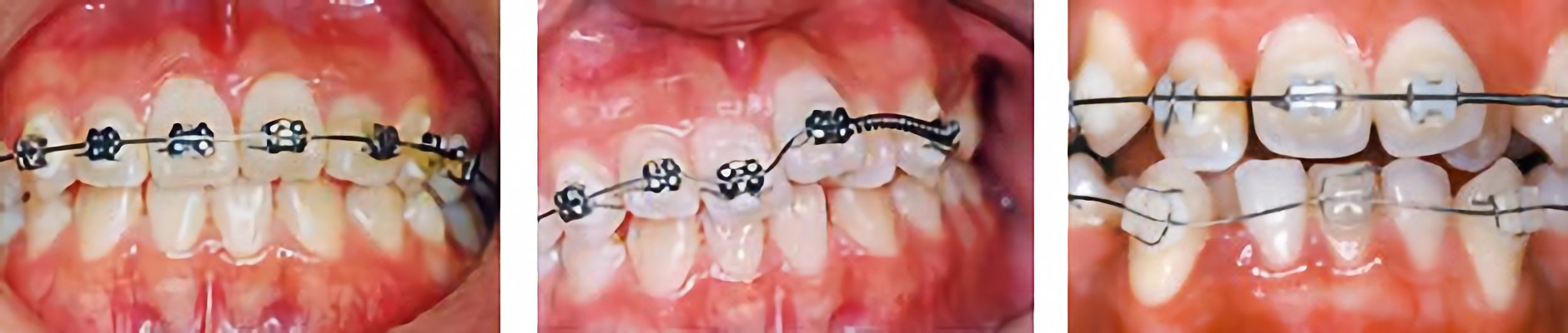 ブラケットとワイヤーを装置し、歯を抜かずに治療します