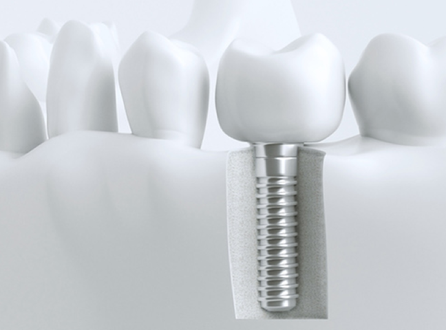 確かな技術と安心の体制でインプラント治療を提供します。