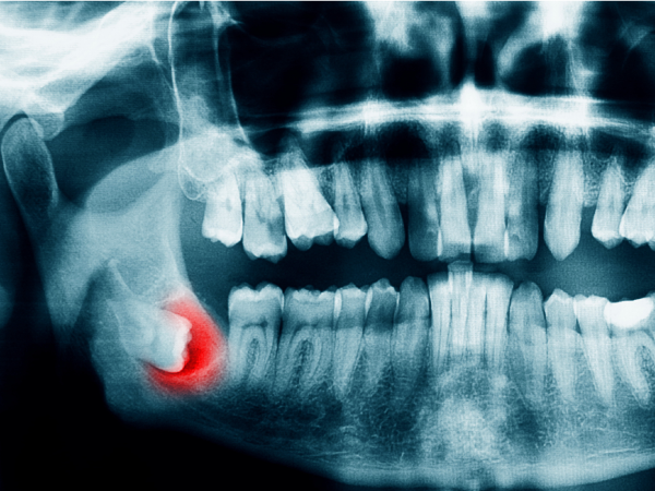 親知らずや顎の痛みもご相談を