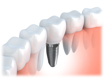 安全で長持ちするインプラント治療を目指しています