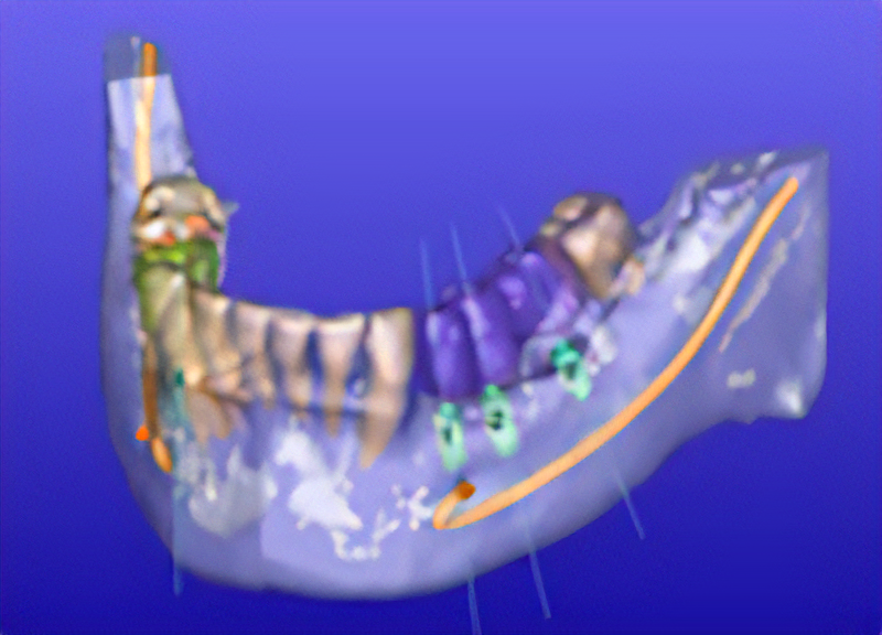 インプラントの埋入のシミュレーション