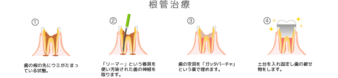 できる限りご自身の歯を長く残せるよう、症状やお口の状態に合わせた適切な治療をご提案いたします。