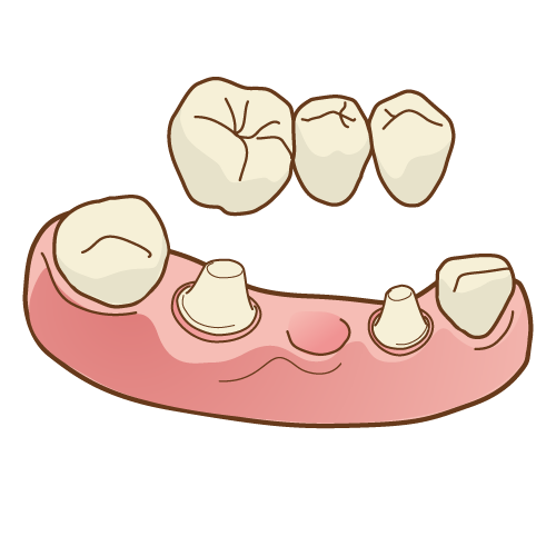 白いセラミックに取り替える治療では、自然な歯の色味や質感を再現し、金属アレルギーのリスクも回避できます