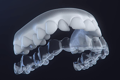 取り外しできるインビザライン