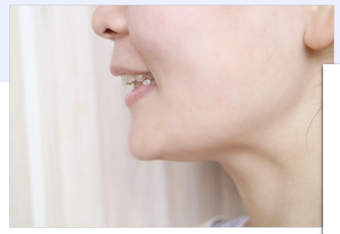 噛み合わせ改善